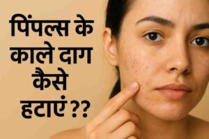 पिम्पल हटाने का तरीका: रातोंरात पिंपल्स दूर करने का अचूक उपाय 4 पिम्पल हटाने का तरीका