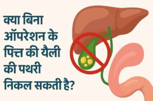 क्या बिना ऑपरेशन के पित्त की थैली की पथरी निकल सकती है? क्या बिना ऑपरेशन के पित्त की थैली की पथरी निकल सकती है?
